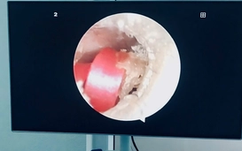 Bé gái suýt thủng màng nhĩ vì dị vật là sợi dây buộc tóc